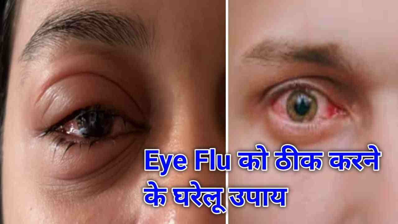 Eye Flu Ko Kaise Thik Kare Gharelu Upay